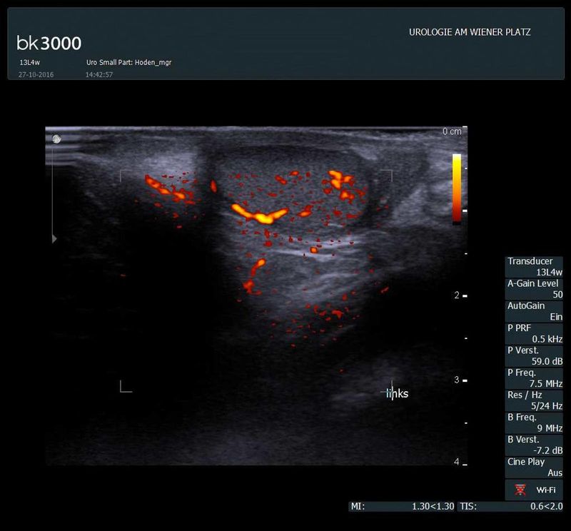 Ultraschalldiagnostik zur Abklärung von Hodenschmerzen